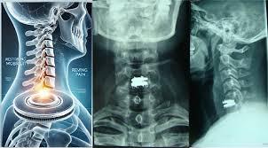 Cervical Disc Replacement