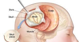 Minimally Invasive Tumor Removal