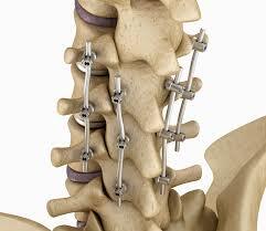 Spinal Fixation
