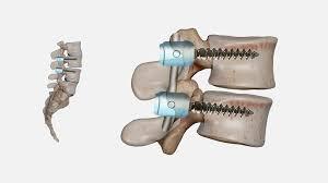 Spinal Fusion