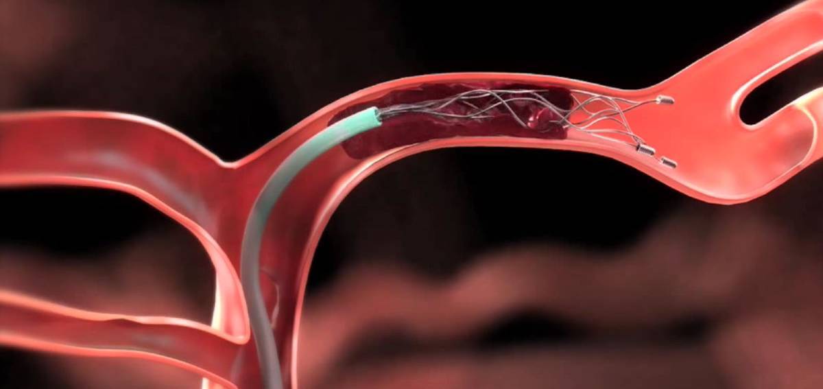 Thrombectomy for Stroke