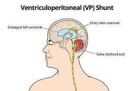 VP Shunt Surgery