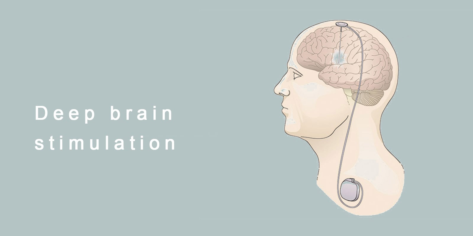 https://spineandbrainhealers.com/wp-content/uploads/2020/07/Deep-brain-stimulation-2-min-1.jpg